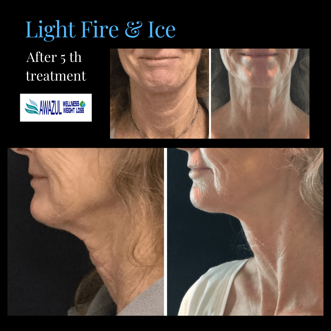 Pelleve RF Rejuvenation Before and After photo by Awazul Wellness & Weight Loss in Kihei, HI