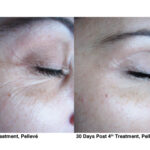 Pelleve RF Rejuvenation Before and After photo by Awazul Wellness & Weight Loss in Kihei, HI