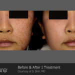 Picosure Before and After photo by Awazul Wellness & Weight Loss in Kihei, HI
