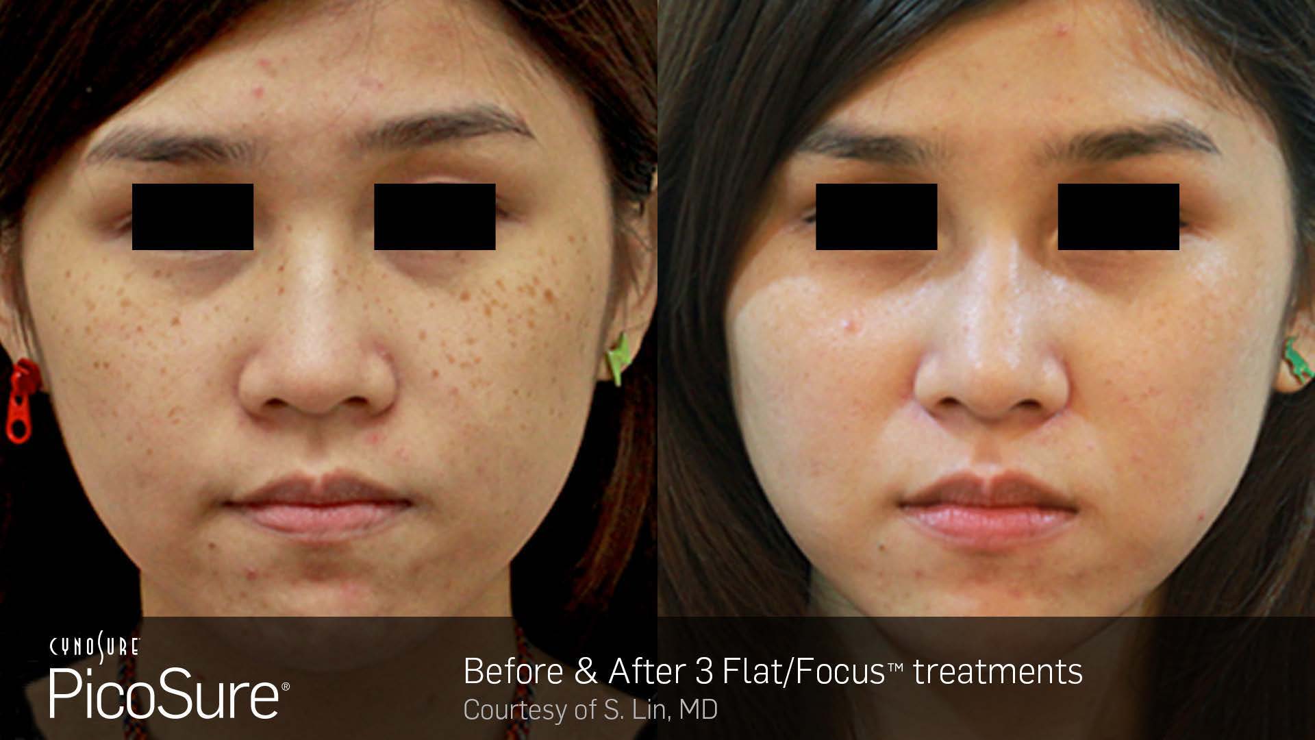 Picosure Before and After photo by Awazul Wellness & Weight Loss in Kihei, HI