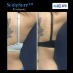SculpSure™ Before and After photo by Awazul Wellness & Weight Loss in Kihei, HI