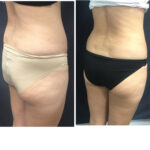 SculpSure™ Before and After photo by Awazul Wellness & Weight Loss in Kihei, HI