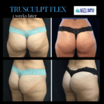 TruSculpt Flex Before and After photo by Awazul Wellness & Weight Loss in Kihei, HI