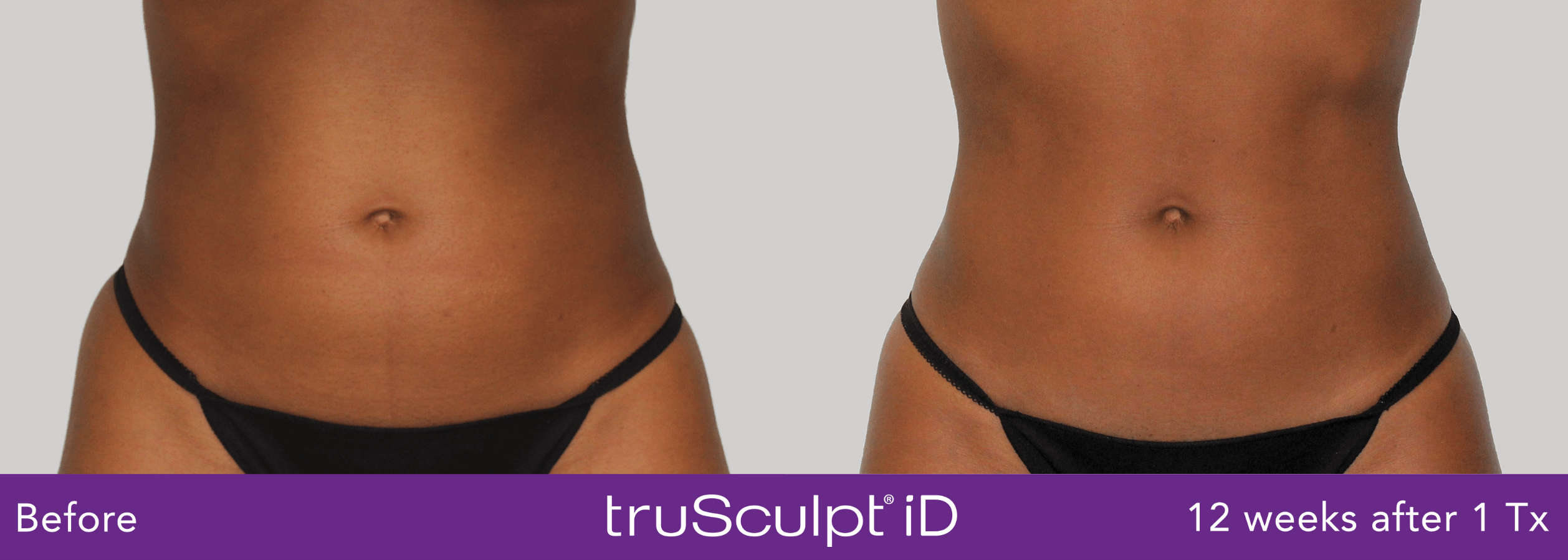 TruSculpt iD Before and After photo by Awazul Wellness & Weight Loss in Kihei, HI