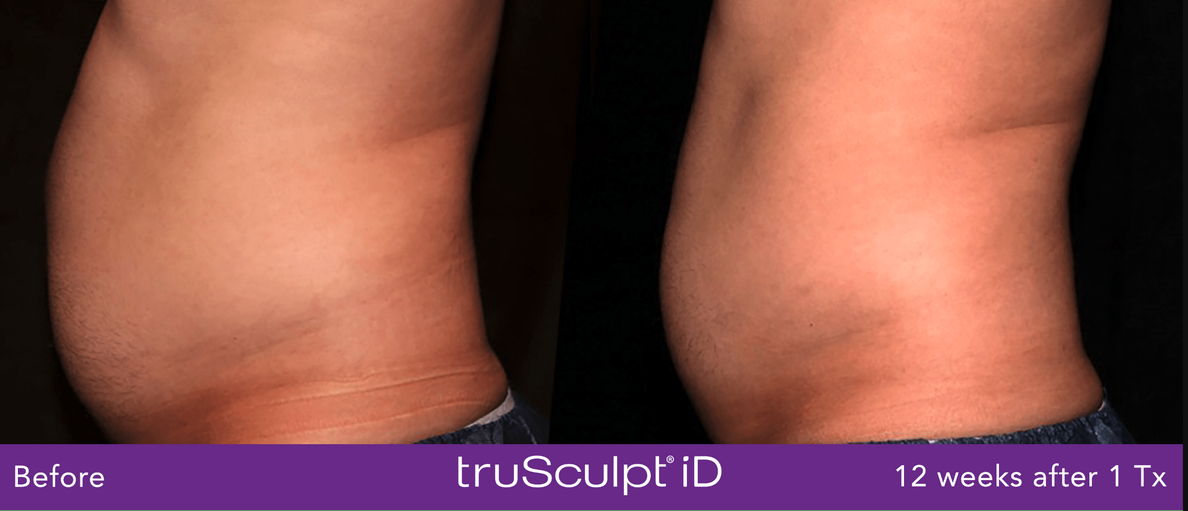 TruSculpt iD Before and After photo by Awazul Wellness & Weight Loss in Kihei, HI