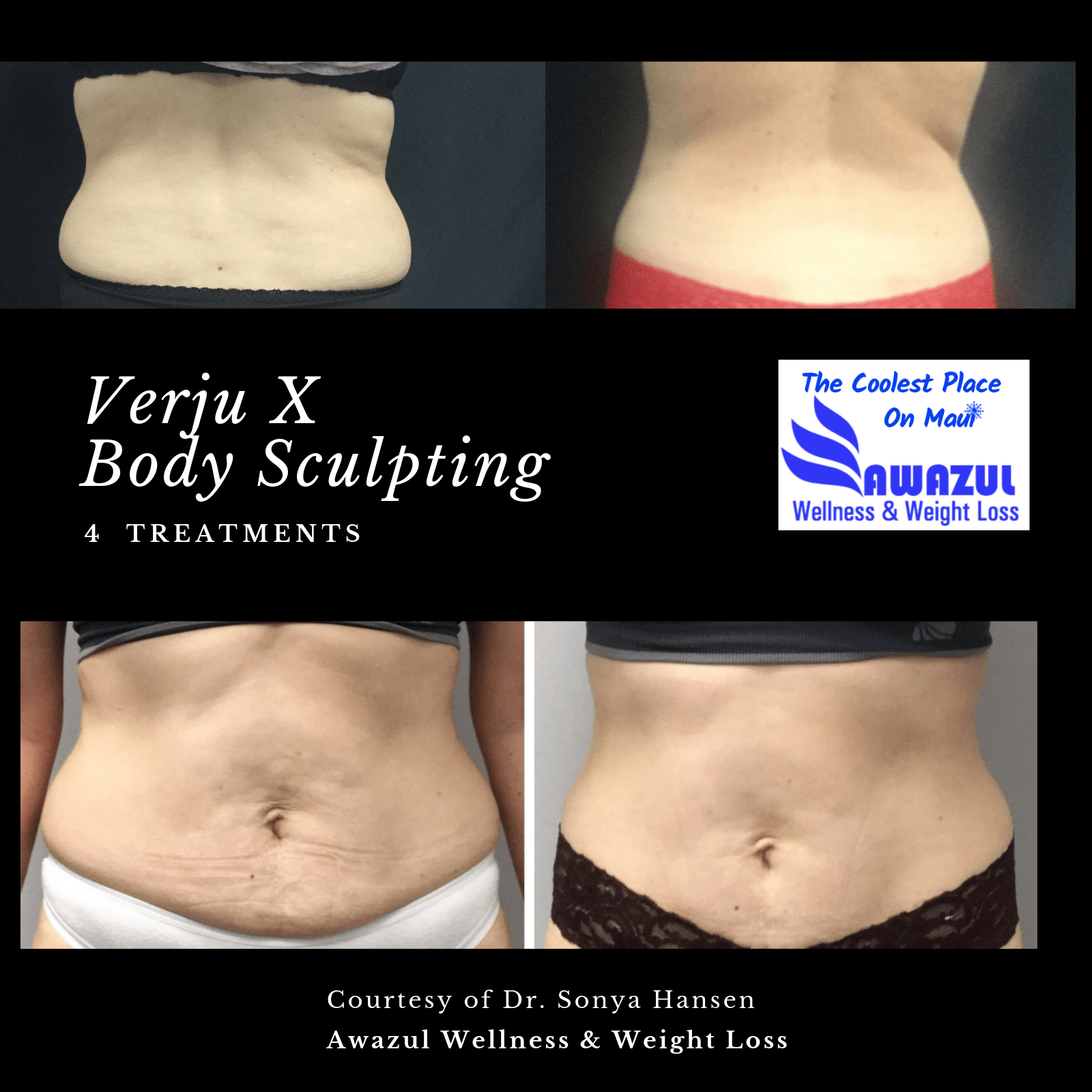 Verju Laser & Vanquish RF Duo Before and After photo by Awazul Wellness & Weight Loss in Kihei, HI