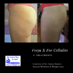 Verju Laser & Vanquish RF Duo Before and After photo by Awazul Wellness & Weight Loss in Kihei, HI
