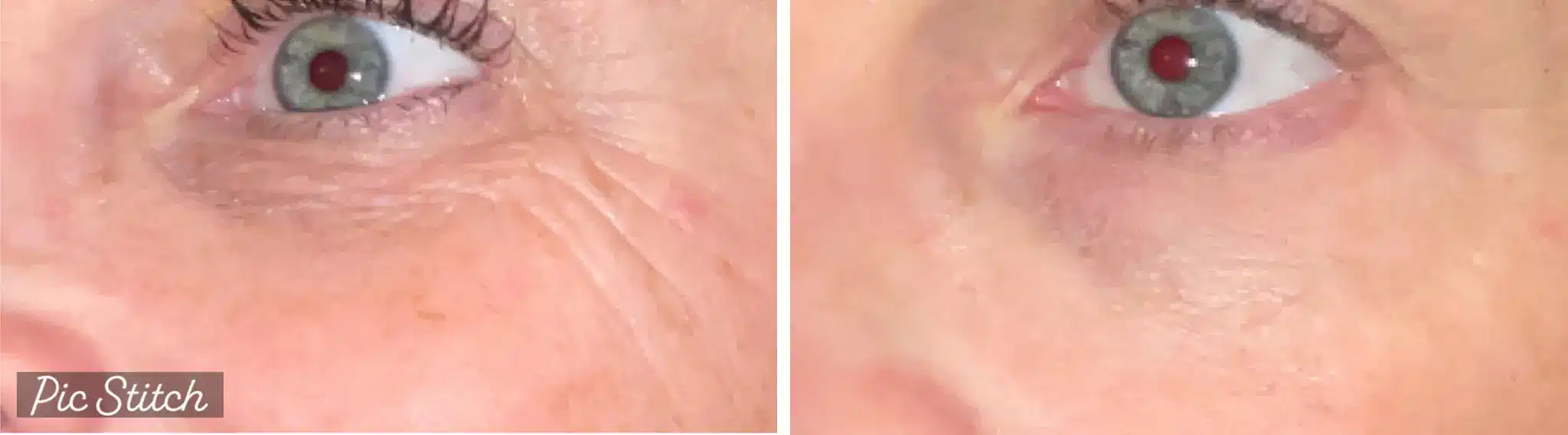 Before and after photos showcasing a woman's eyes following CO2 laser resurfacing treatment