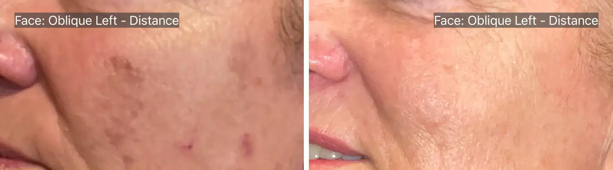 Before and after photos of a woman’s face showing improvement in acne after CO2 laser resurfacing treatment