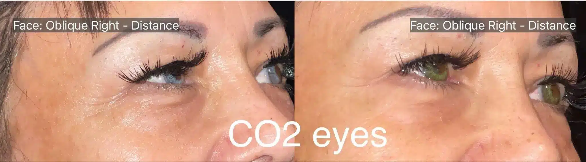 Before and after photos of a woman’s face showing improvement in acne after CO2 laser resurfacing treatment